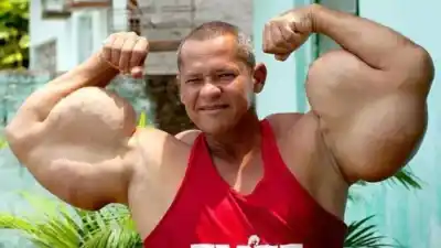 Recife: la trágica historia del “Popeye brasileño” que se inyectó aceite por 30 años