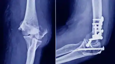 ANMAT detecta un tornillo quirúrgico falsificado en una ortopedia de San Miguel de Tucumán
